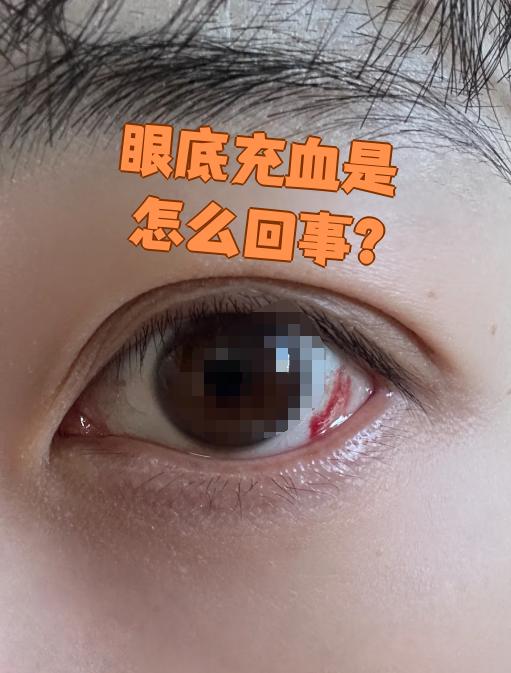 眼底充血是眼睛表面血管扩张的表现,常见原因有四种