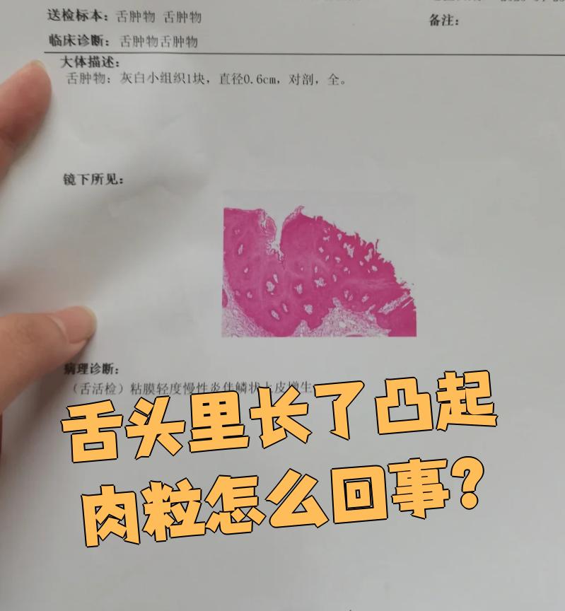 舌头里面长凸起肉粒可能是舌乳头状瘤或肉芽肿引起的