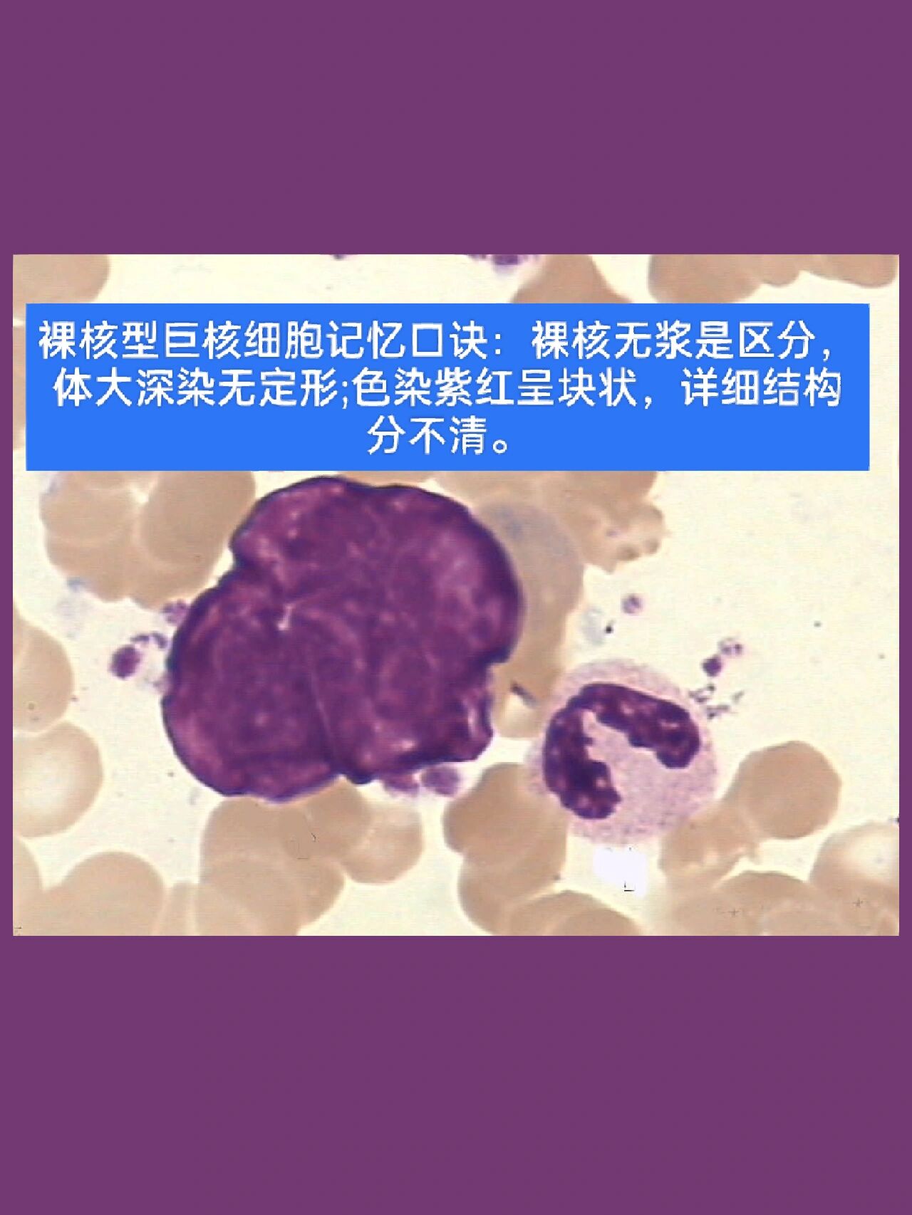 巨核细胞系统(巨核系)包括原始巨核细胞,幼稚巨核细胞,颗粒性巨核细胞
