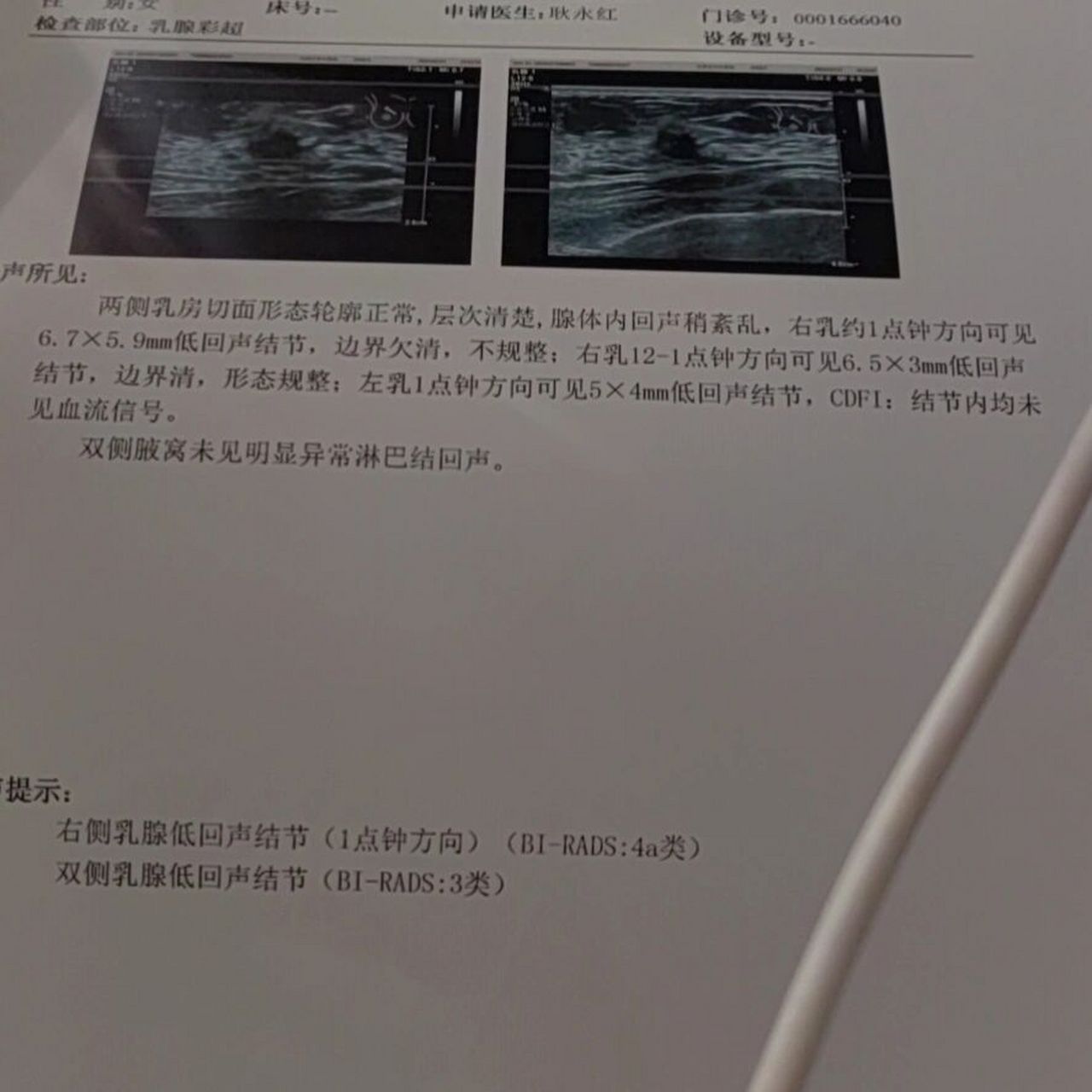 乳腺结节4a,必须要手术吗 上个月去市中医院查出来乳腺结节有一个4a