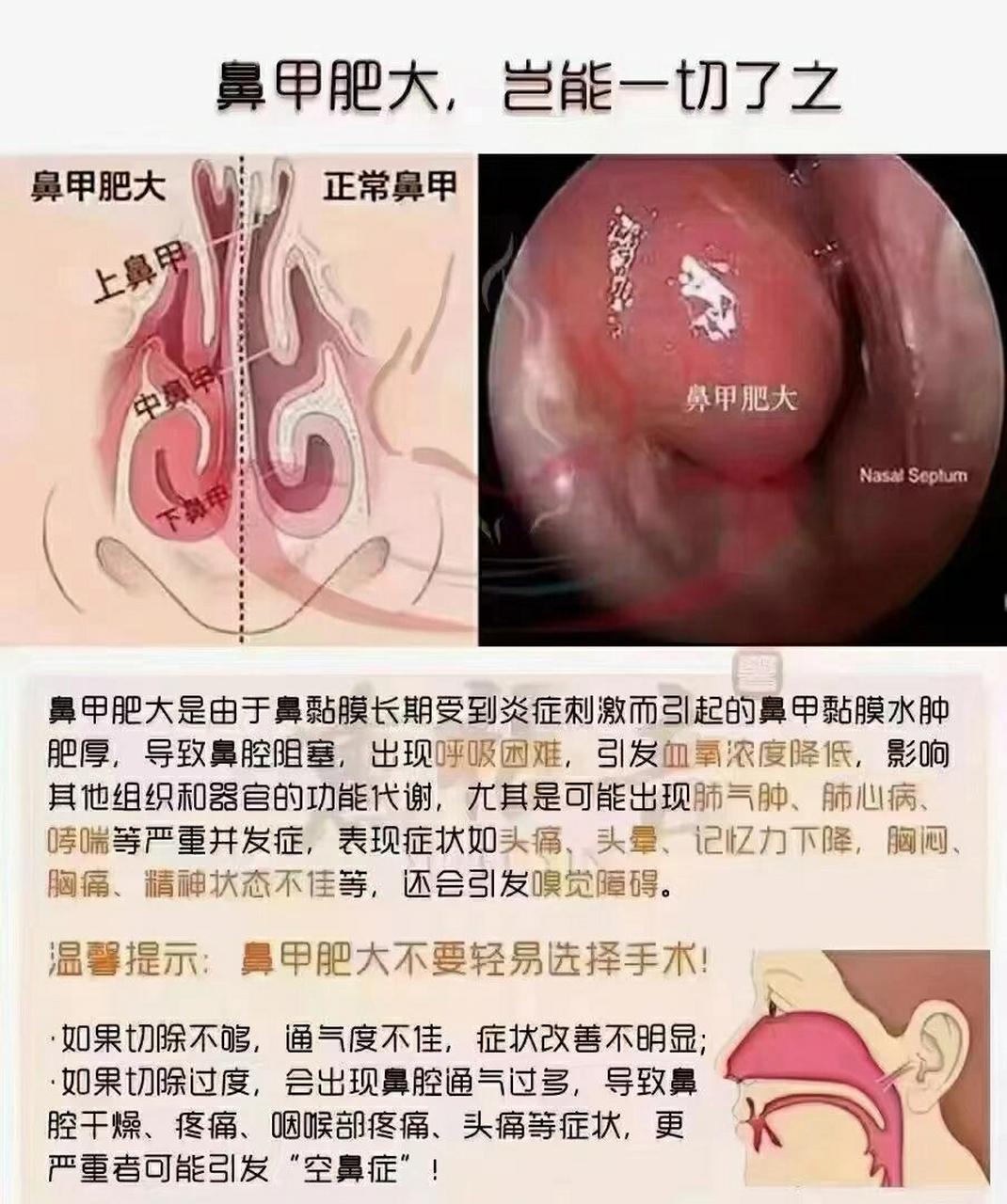 鼻粘膜位置图片图片