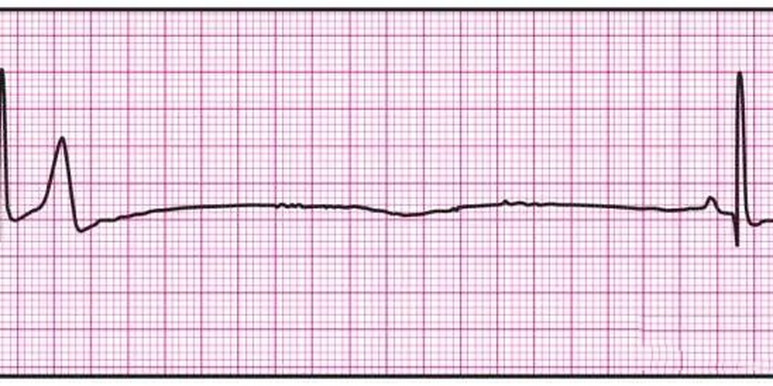 窦性停搏 窦性停搏】 图片 心房(和心室)停止活动达到4s 窦房结不能