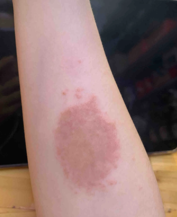 胳膊上出现圆形癣块,最常见的原因是紫外线照射,花斑糠疹或体癣