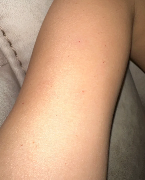 手臂出现针状小红血点可能是血管瘤或过敏性紫癜引起的,需要根据