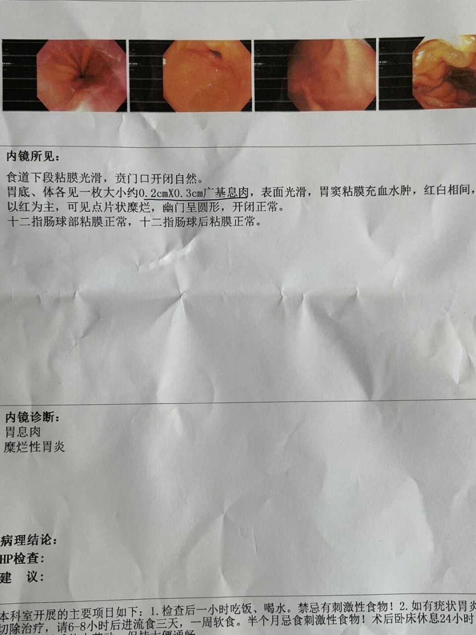 糜烂性胃炎77胃息肉 养胃模式!