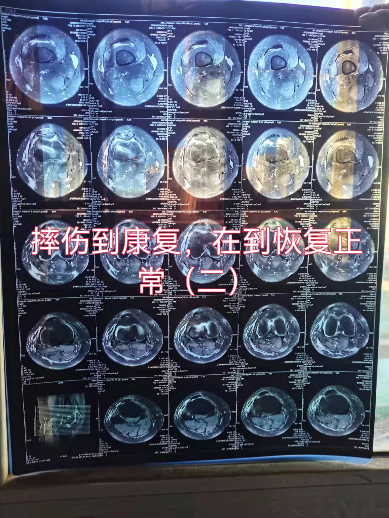 左膝关节髌骨支持带内侧韧带损伤 2021年10月31日 当时准备回当地做