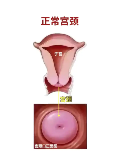 正常子宫口通常指的是子宫颈外口,它是连接子宫颈管和阴道的开口