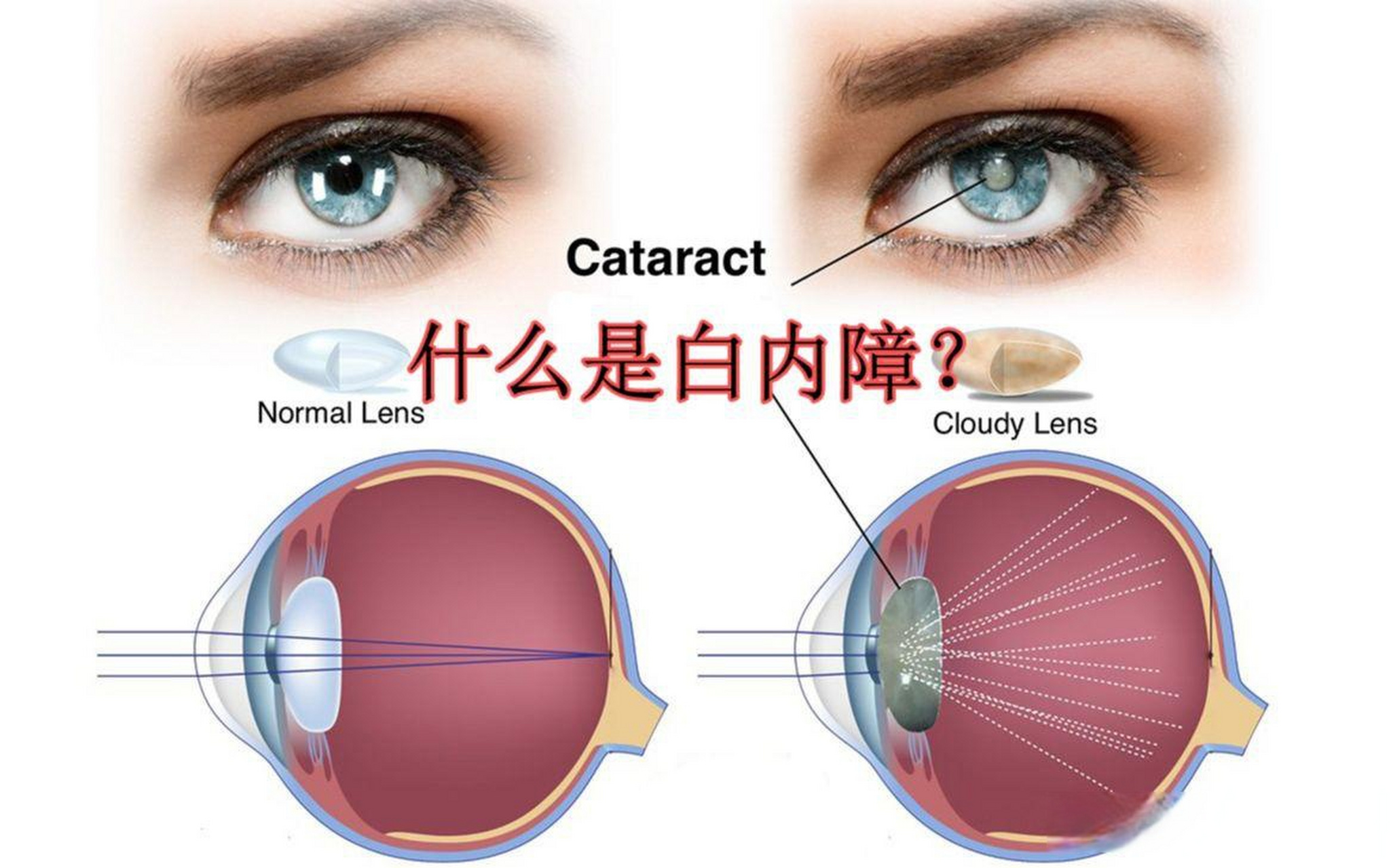 老年性白内障是指中老年时期开始发生的晶状体浑浊.