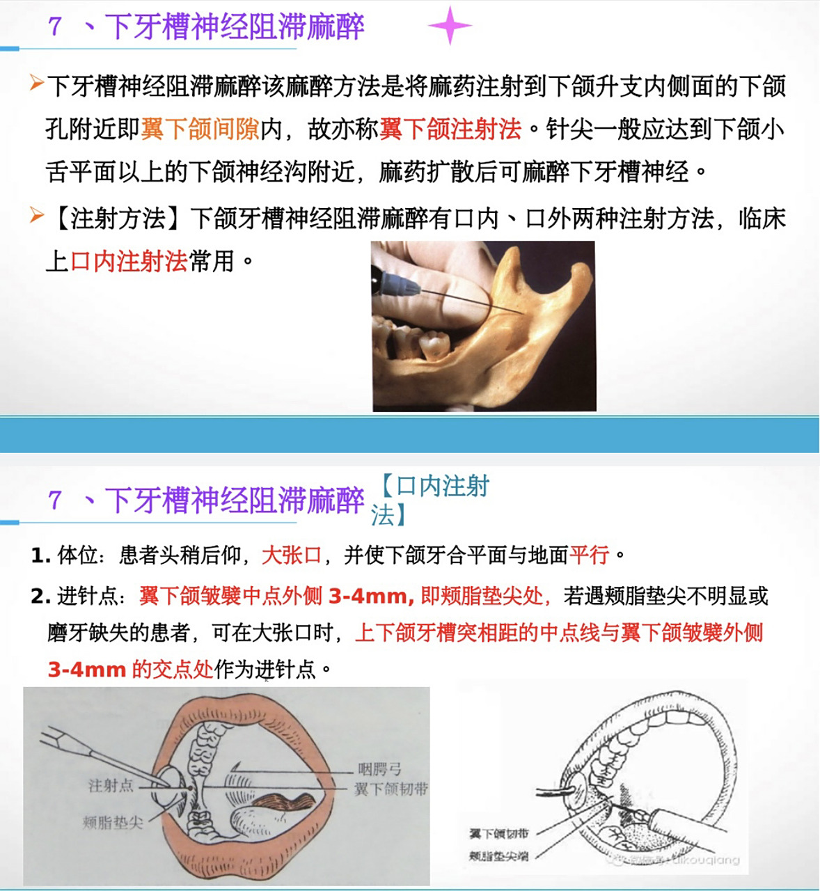 下牙槽神经阻滞麻醉口内注射法