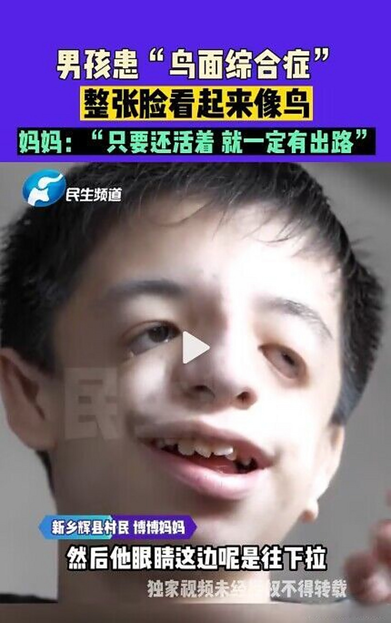 男孩患鸟面综合症#看了视频,这男孩的妈妈显然也是鸟面综合症患者啊