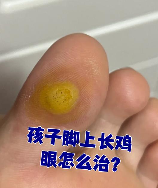 如果鸡眼症状不严重,可以用水杨酸软膏来软化它