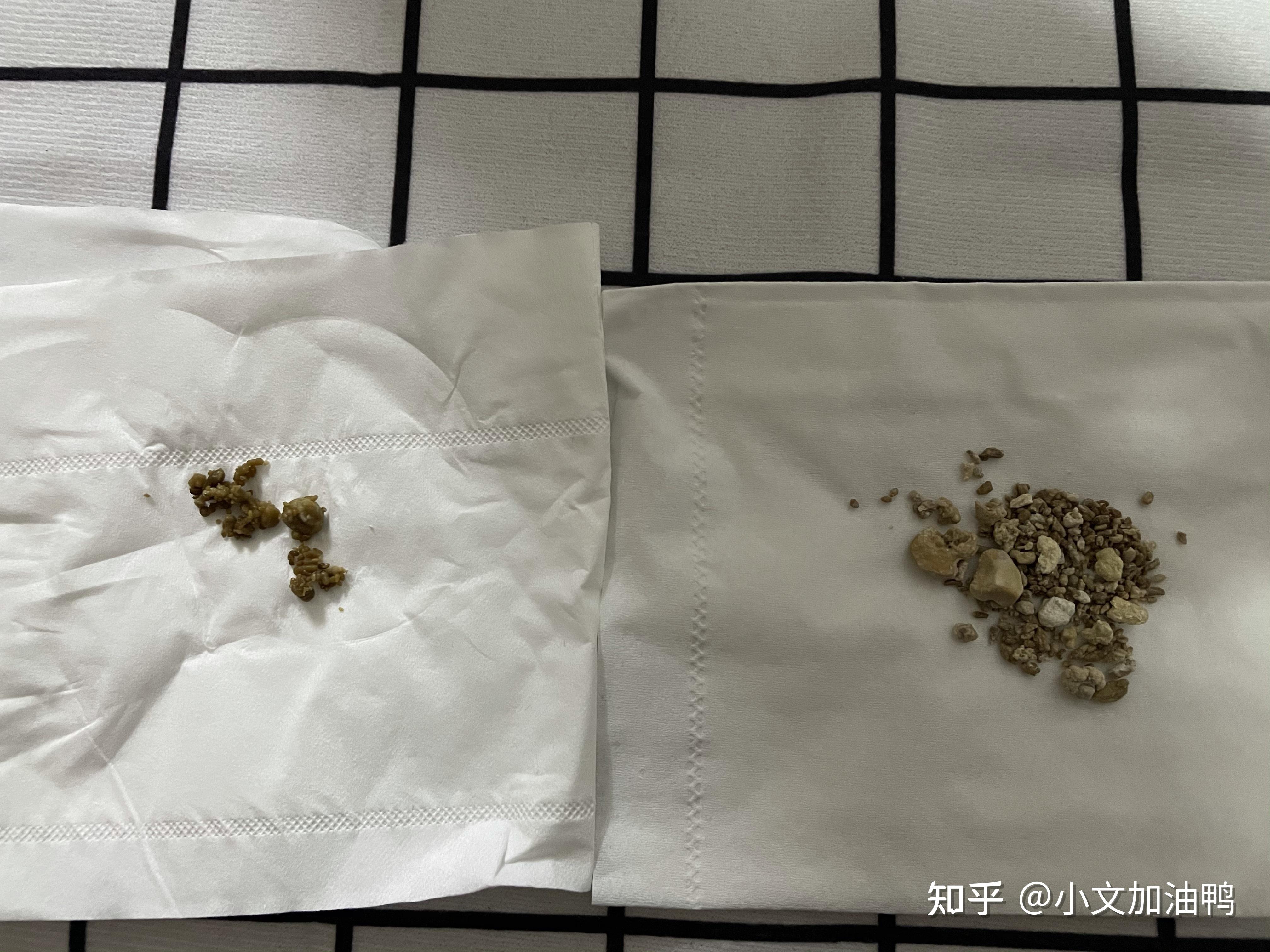 得了海绵肾是种什么体验