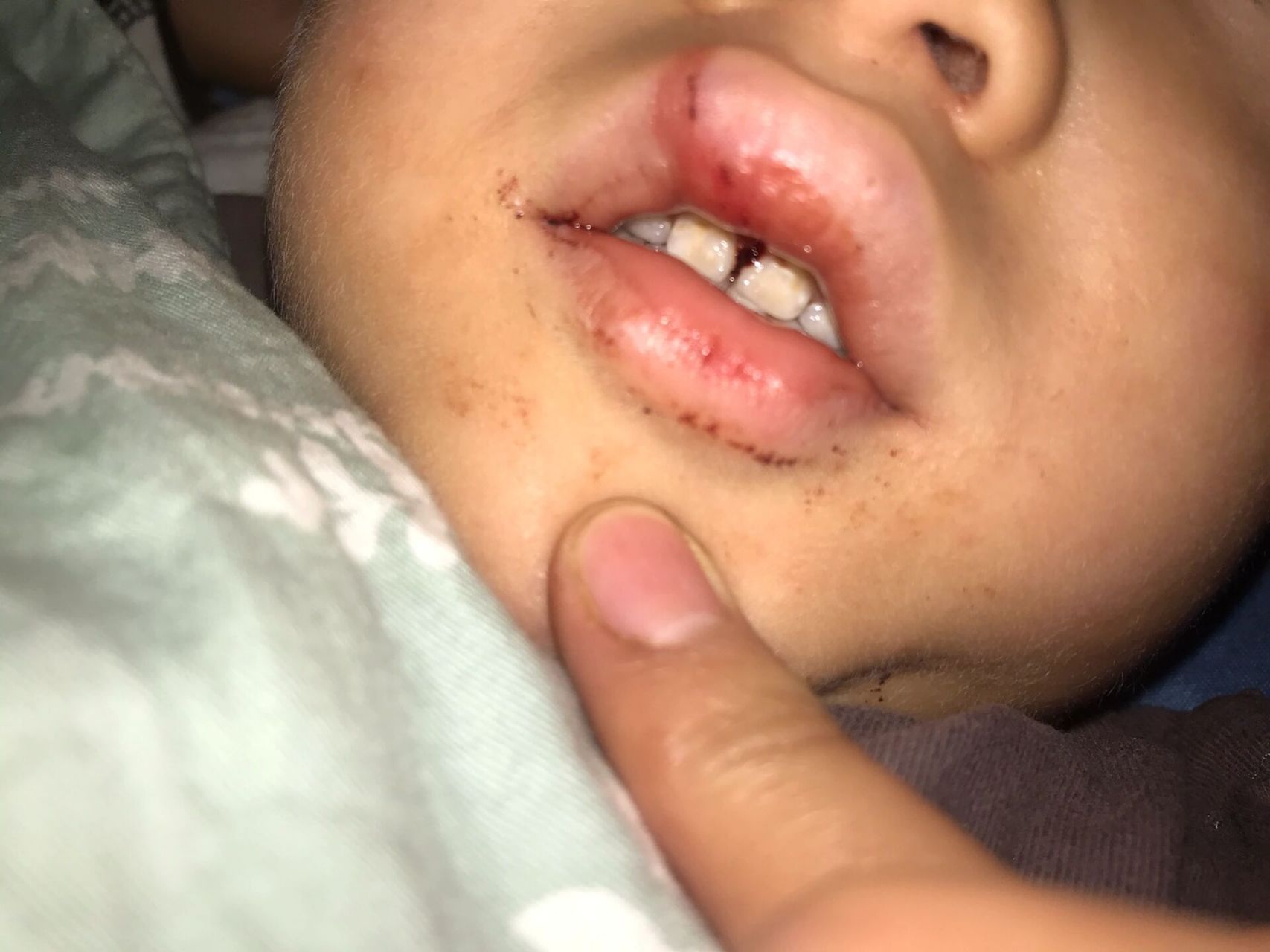 两岁宝子摔断唇细带缝针了 一个月了,现在看来缝针