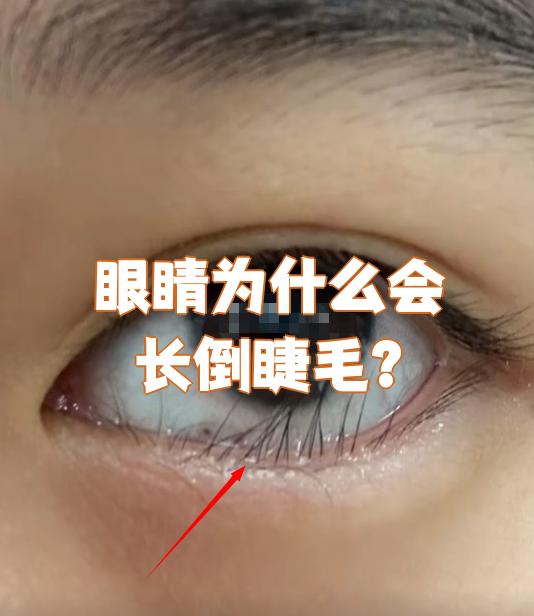 内眼角长睫毛是倒睫吗百科在线