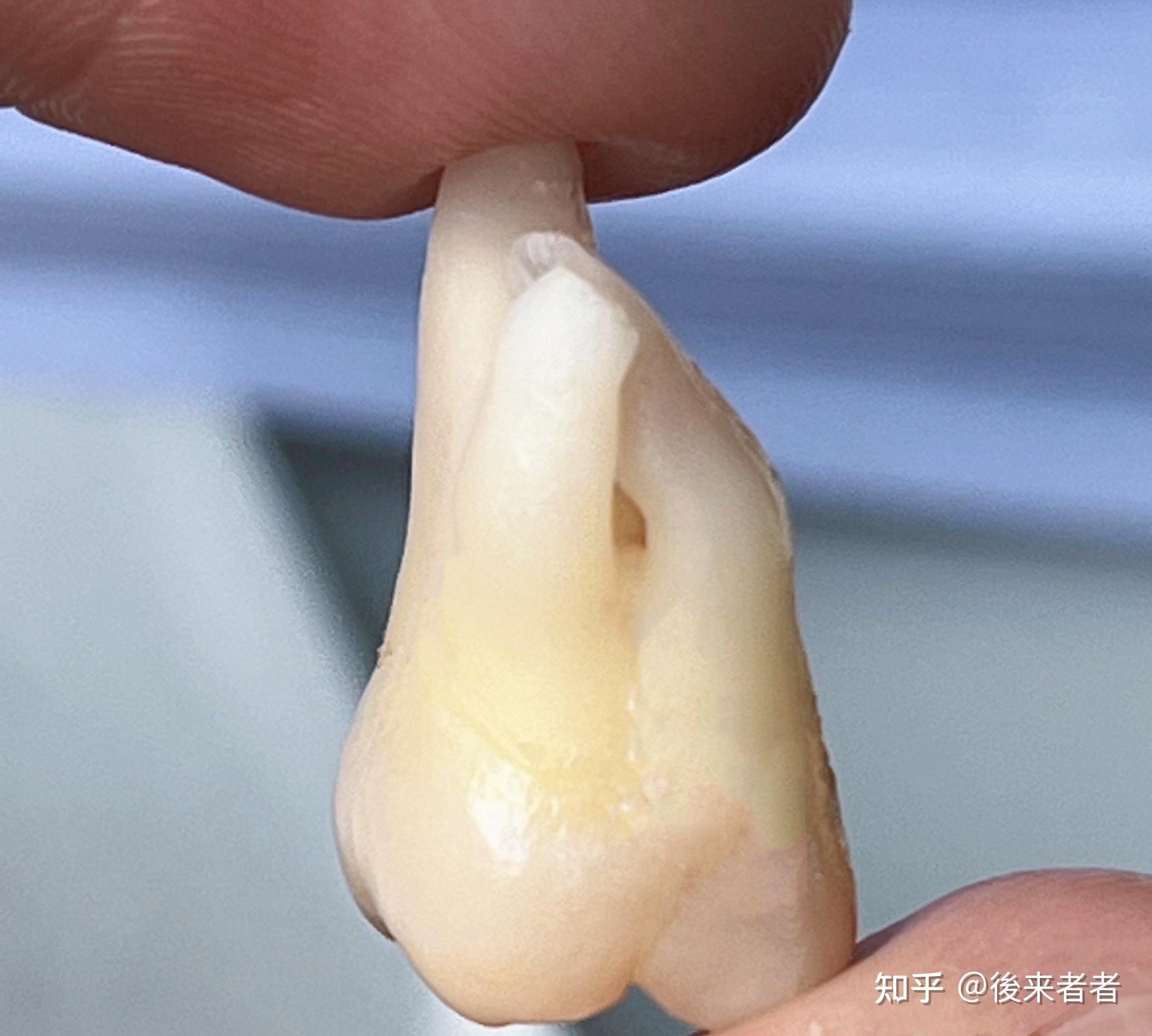 请问智齿牙根是弯的好拔吗