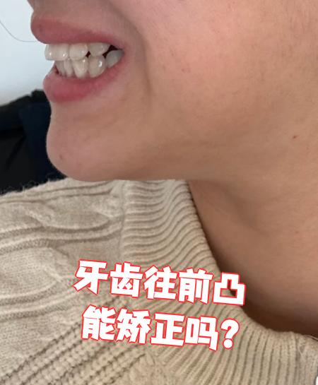 牙齿往前凸是可以矫正的,具体方法要根据病因来选择