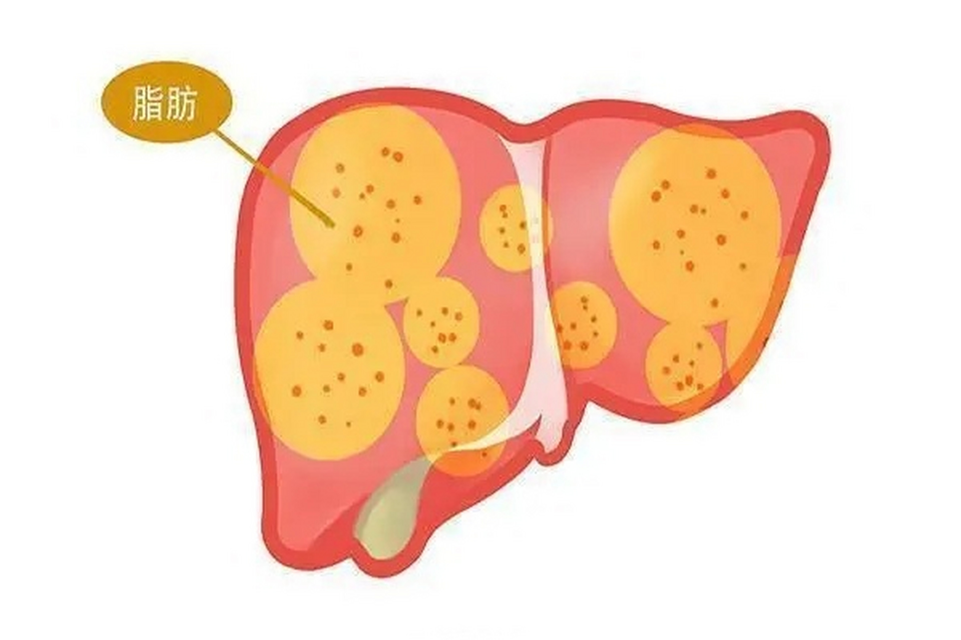 脂肪肝的并发症有哪些# 脂肪肝的常见并发症有哪些?