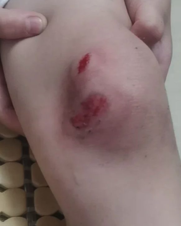 腿撞破皮还肿了,可以这样处理:
