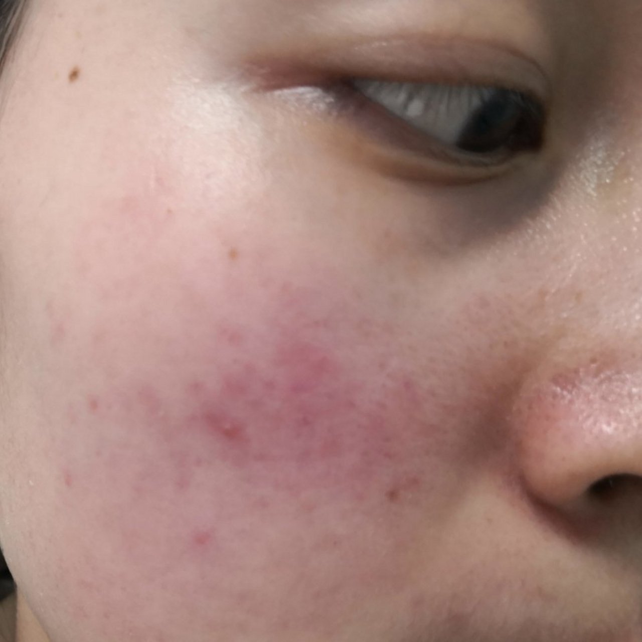 考虑玫瑰痤疮症状#玫瑰痤疮##酒渣鼻