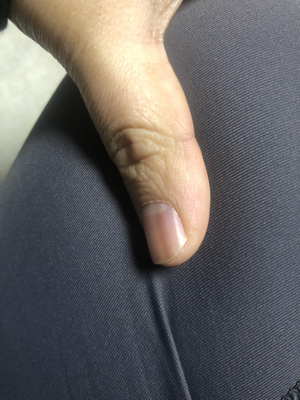 甲黑线 大拇指的黑线,应该有二十几年了,刷到"甲母痣"以后,整个人都不