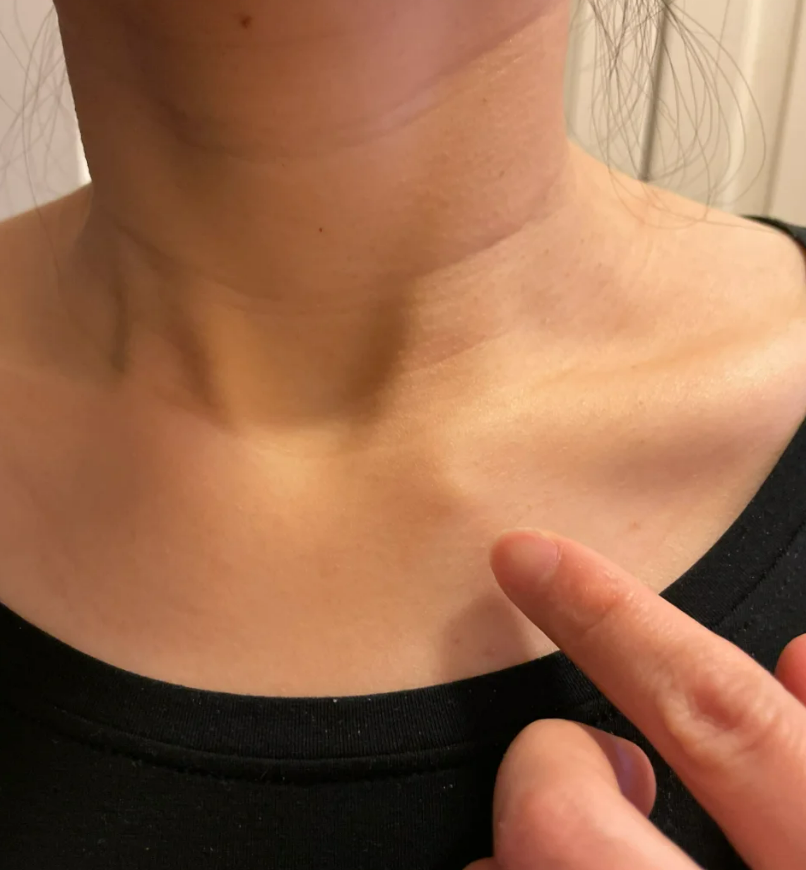 锁骨摸到能滑动,按压痛的疙瘩,常见原因包括毛囊炎,淋巴结炎和皮脂