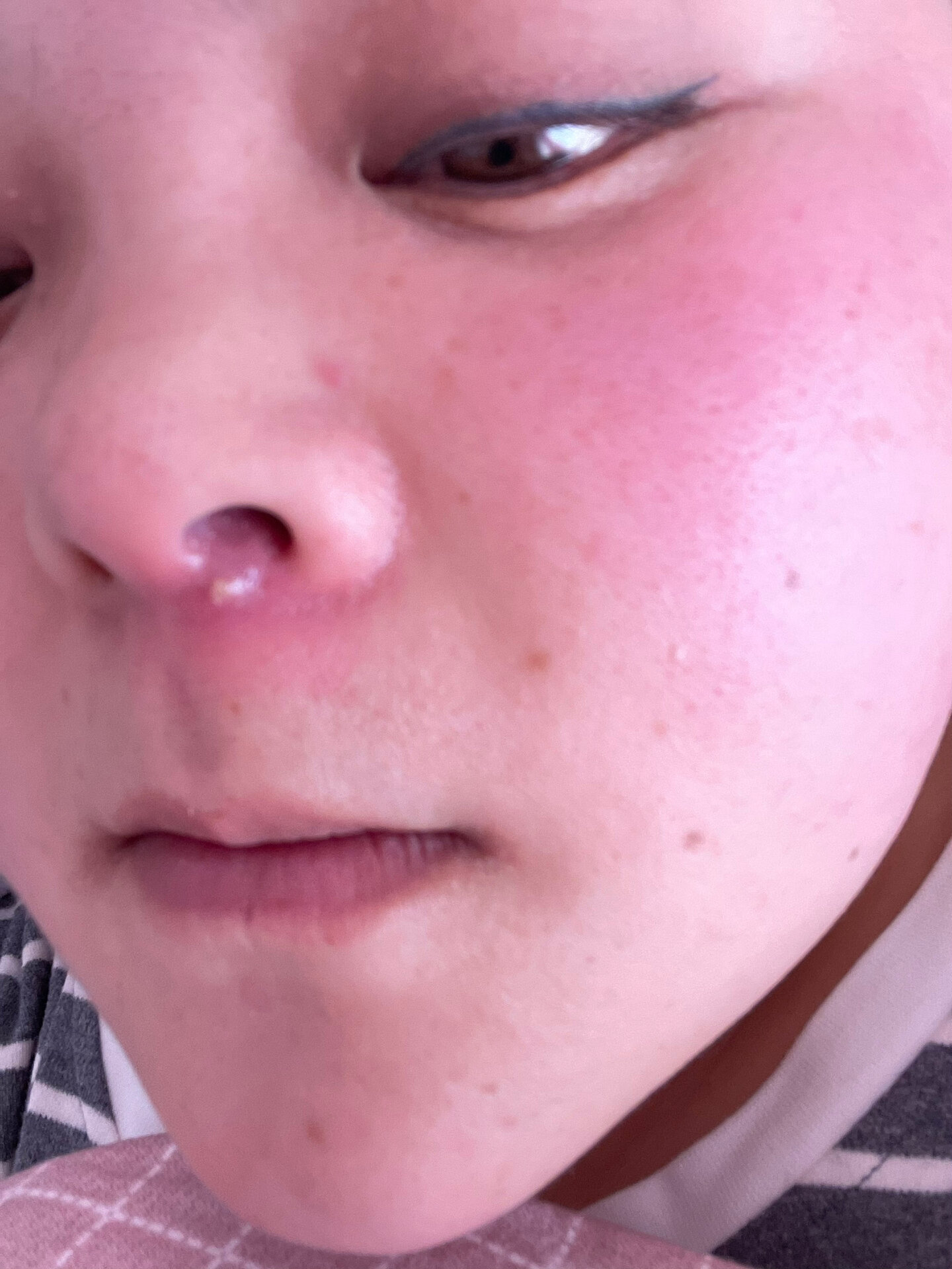 咋的我立马去了医院鼻子上长火疖子图片鼻前庭囊肿图片鼻前庭疖肿鼻孔