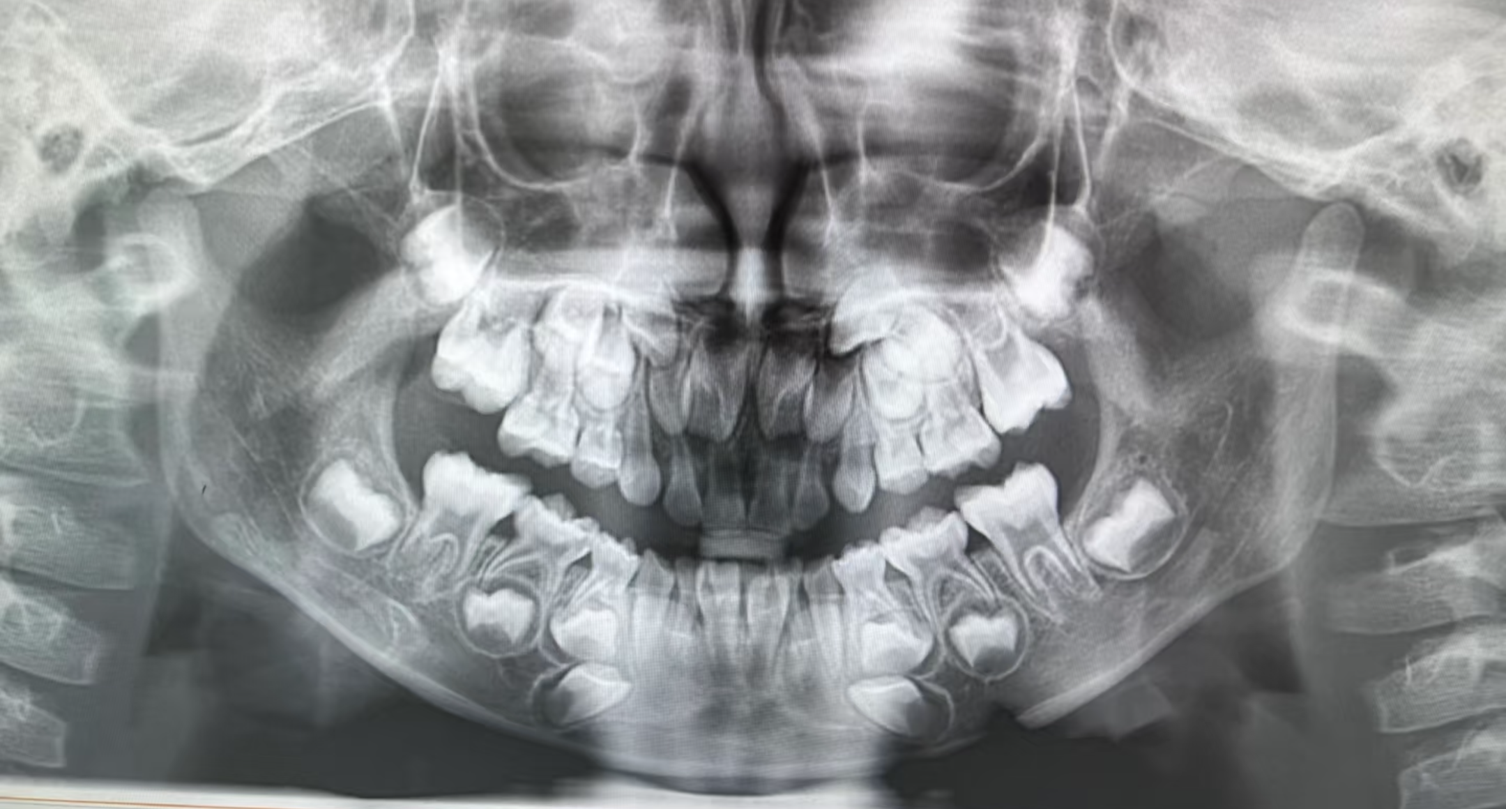 孩子换牙时乳牙没掉恒牙就长出来了,这种情况可以先观察或者去医院