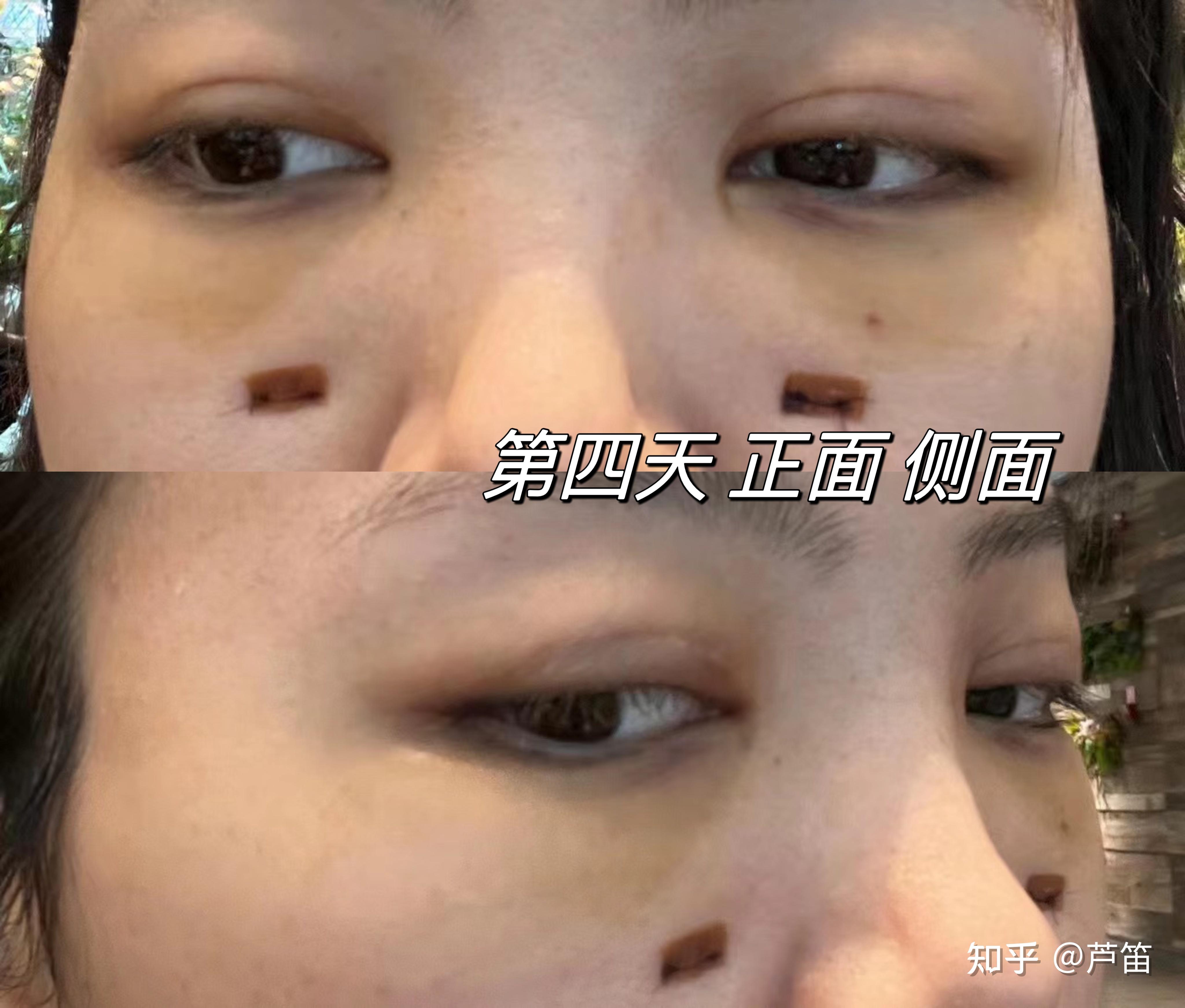 你的眼袋内切手术恢复的怎么样