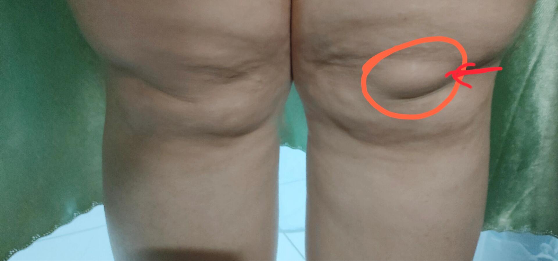 膝盖疼痛有小鼓包 如题,左侧膝盖有个软软的小包,顺着小包边缘往凹陷