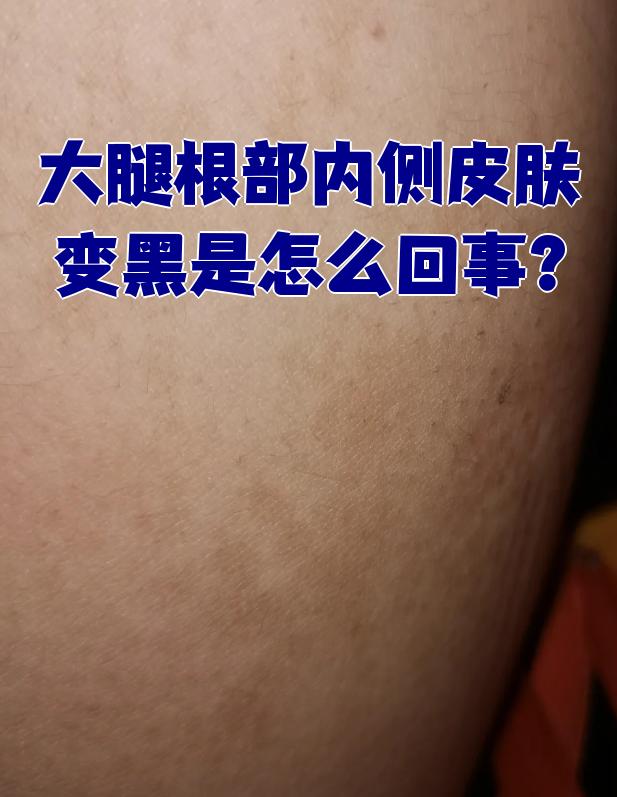 大腿根部内侧皮肤变黑最常见的原因是色素沉积,慢性皮炎或黑棘皮 .