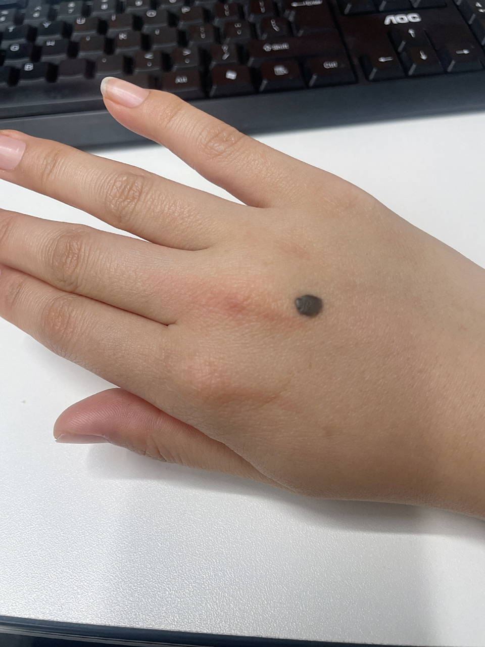 黑色素瘤 姐妹们这是黑色素瘤吗 很小的时候长得不是天生的 如果要动