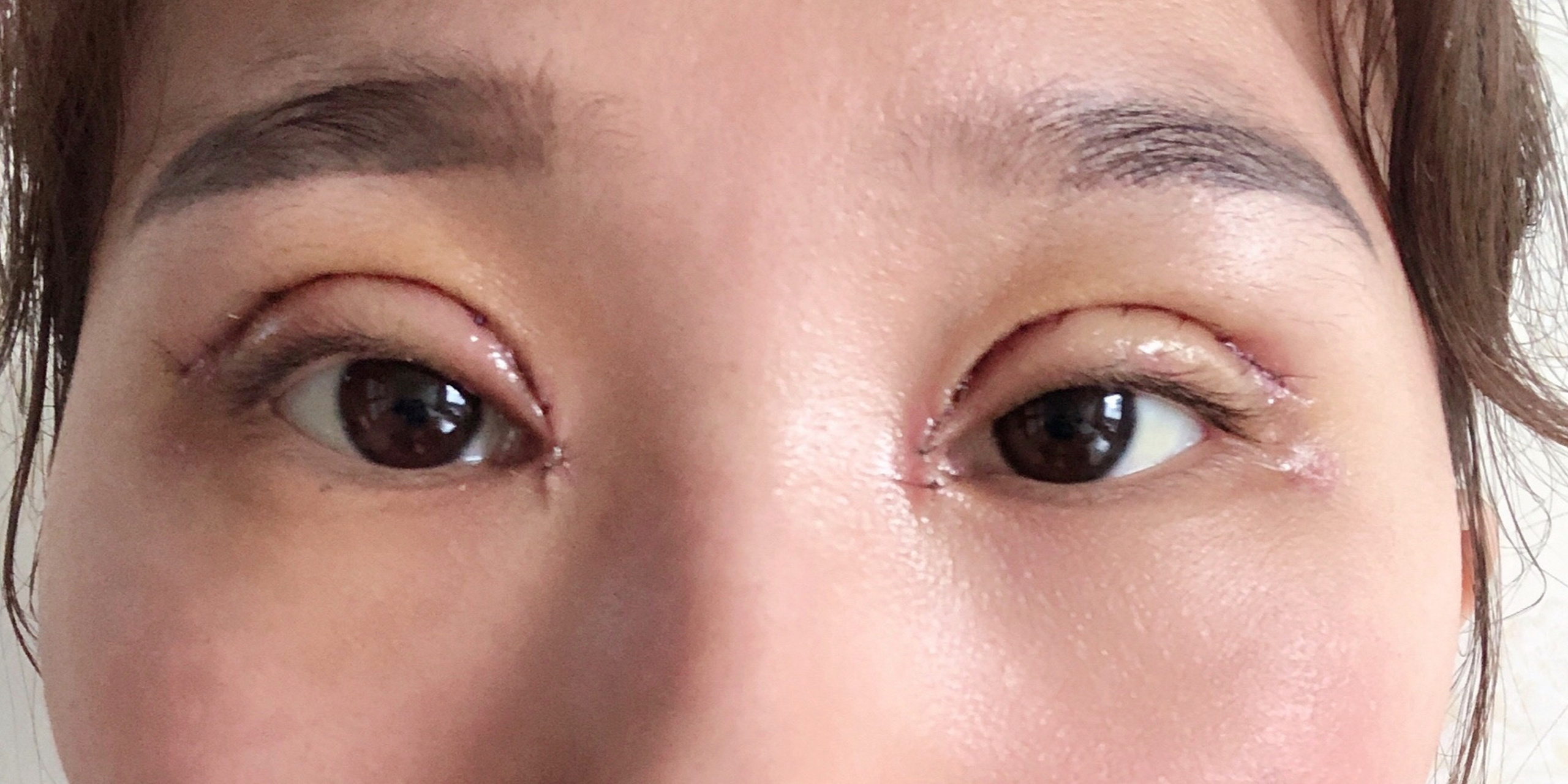 双眼皮第四天,内眼角有点红肿,给长了个小疙瘩似的,这是什么原因