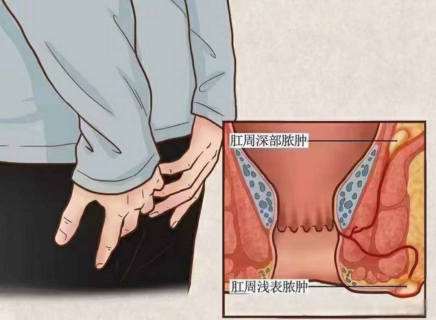 肛周脓肿,又称肛管直肠周围脓肿,中医称为肛痈.