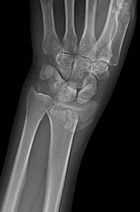 手腕骨折100天后手指还僵硬,这很常见