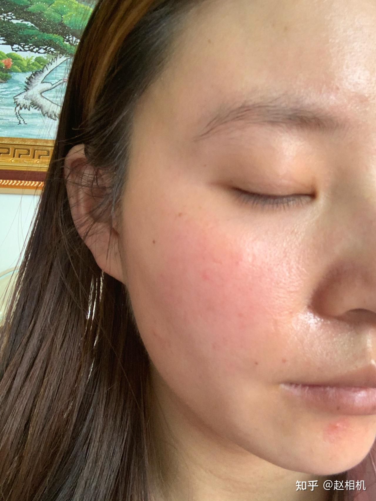 皮肤很不好脸部角质层薄导致皮肤敏感很难看求大神指点