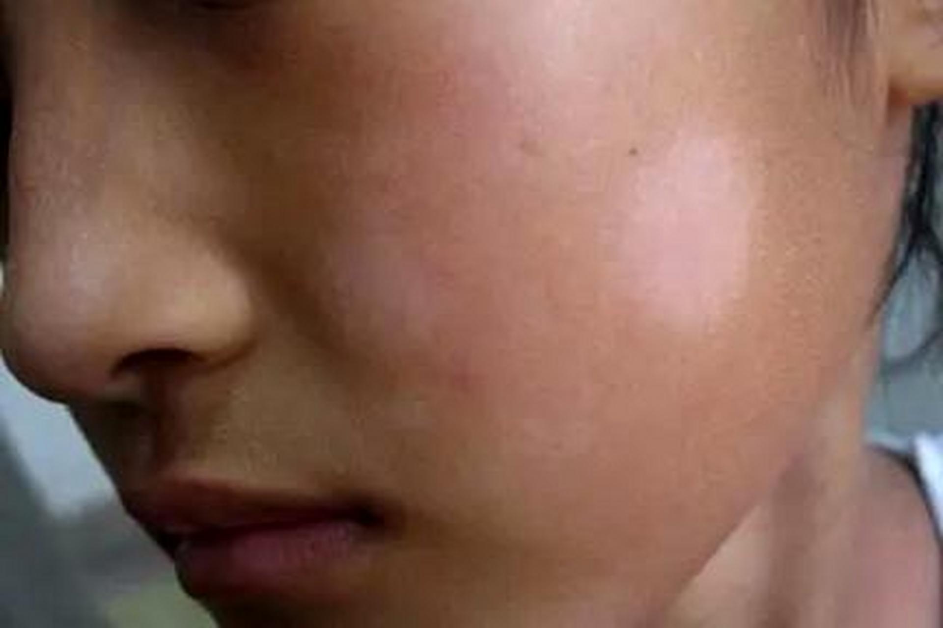 孩子脸上有一块一块的白斑还覆有细糠状的鳞屑是怎么回事?