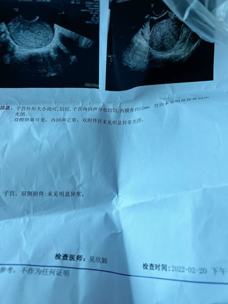 大姨妈推迟11天,做了阴超,验了尿,没怀孕03