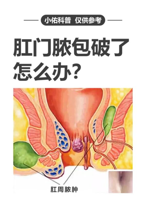 肛门脓包破了怎么办?