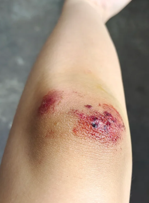 皮肤破了能不能洗澡要看伤口情况