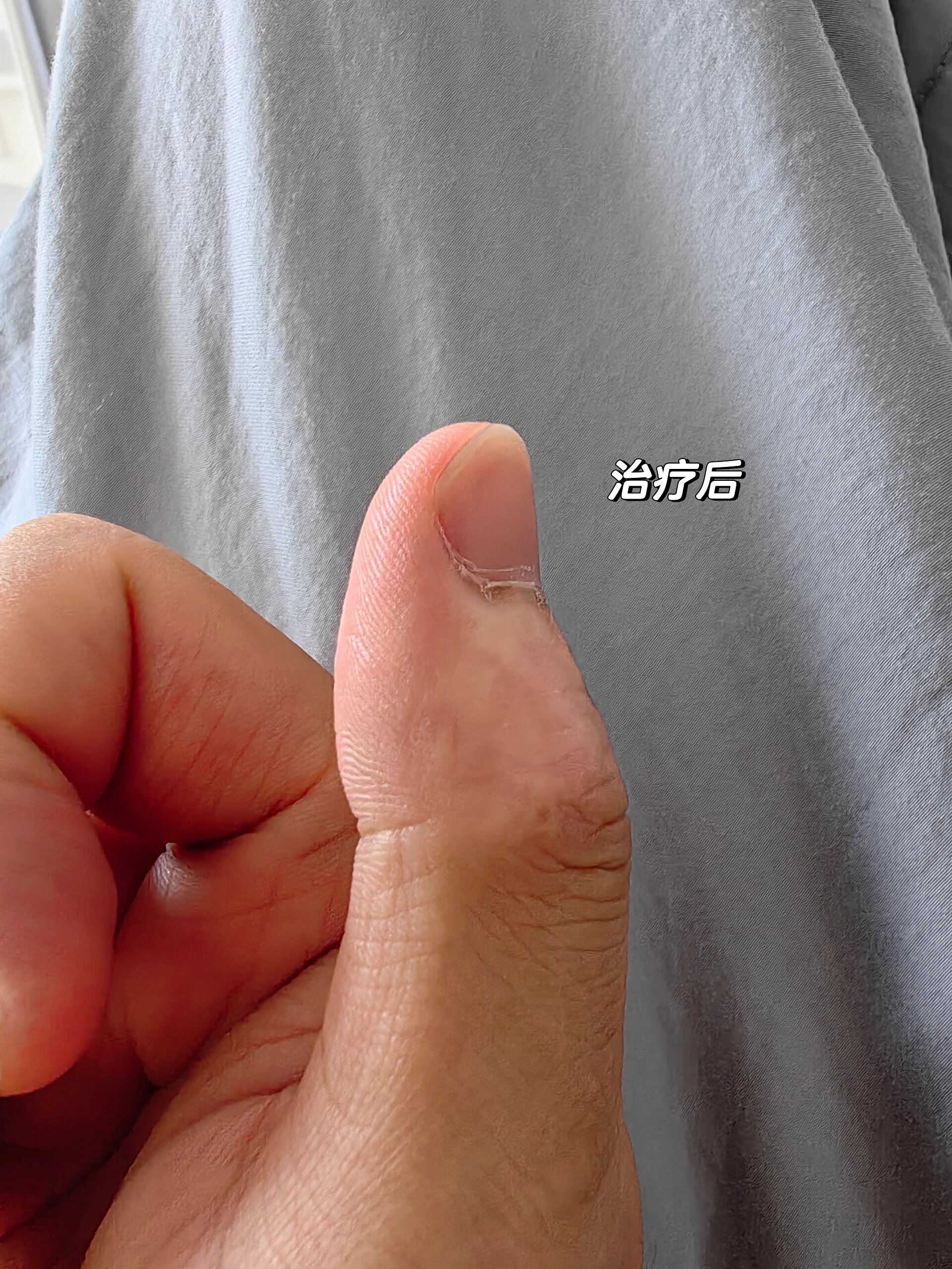 寻常疣治愈过程 本人大拇指头长了一个寻常疣,去家附近的医院看,大夫
