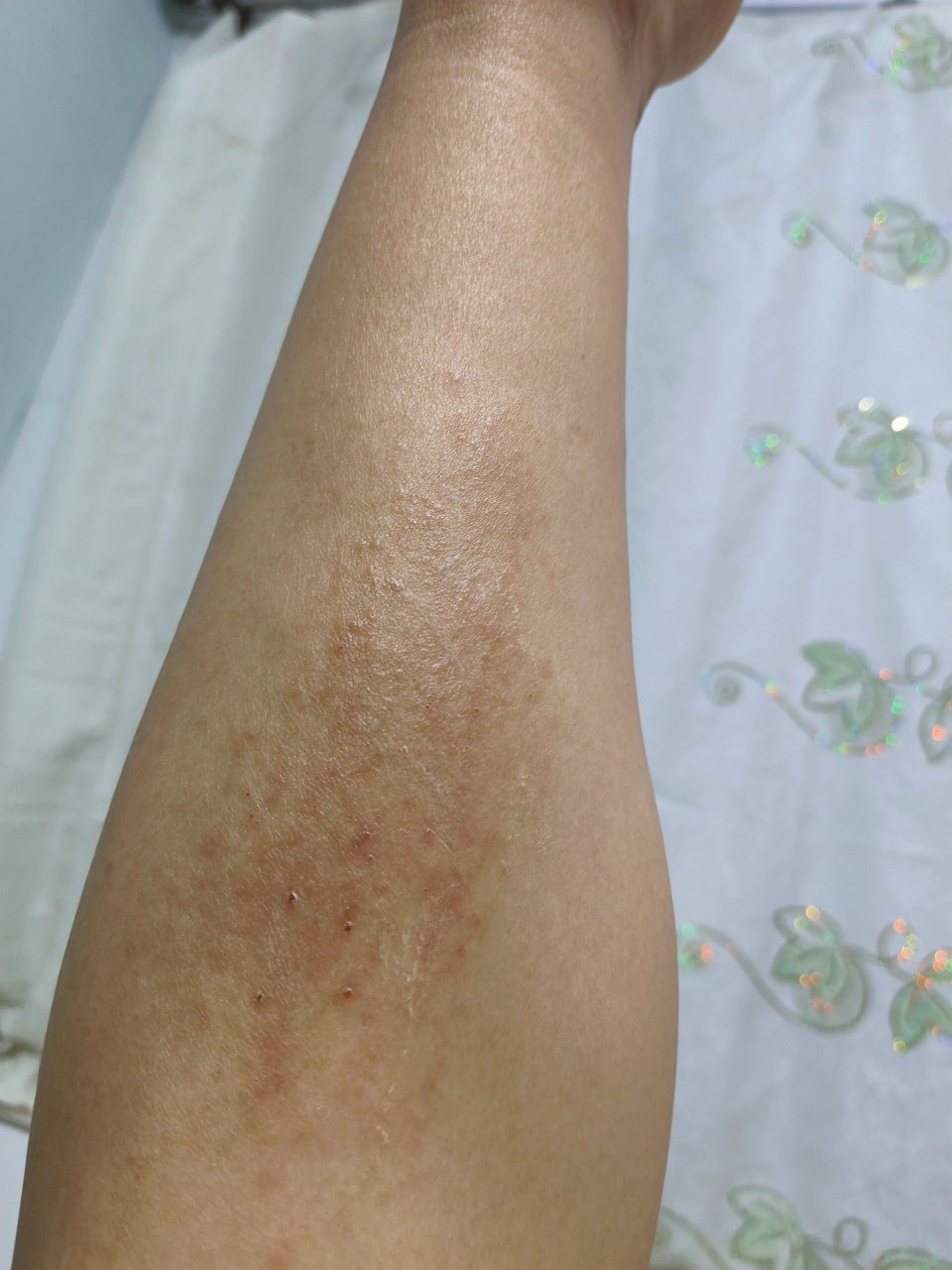小腿起了一片疙瘩 一个月以前就觉得腿有点痒我就挠挠挠的 越挠越红