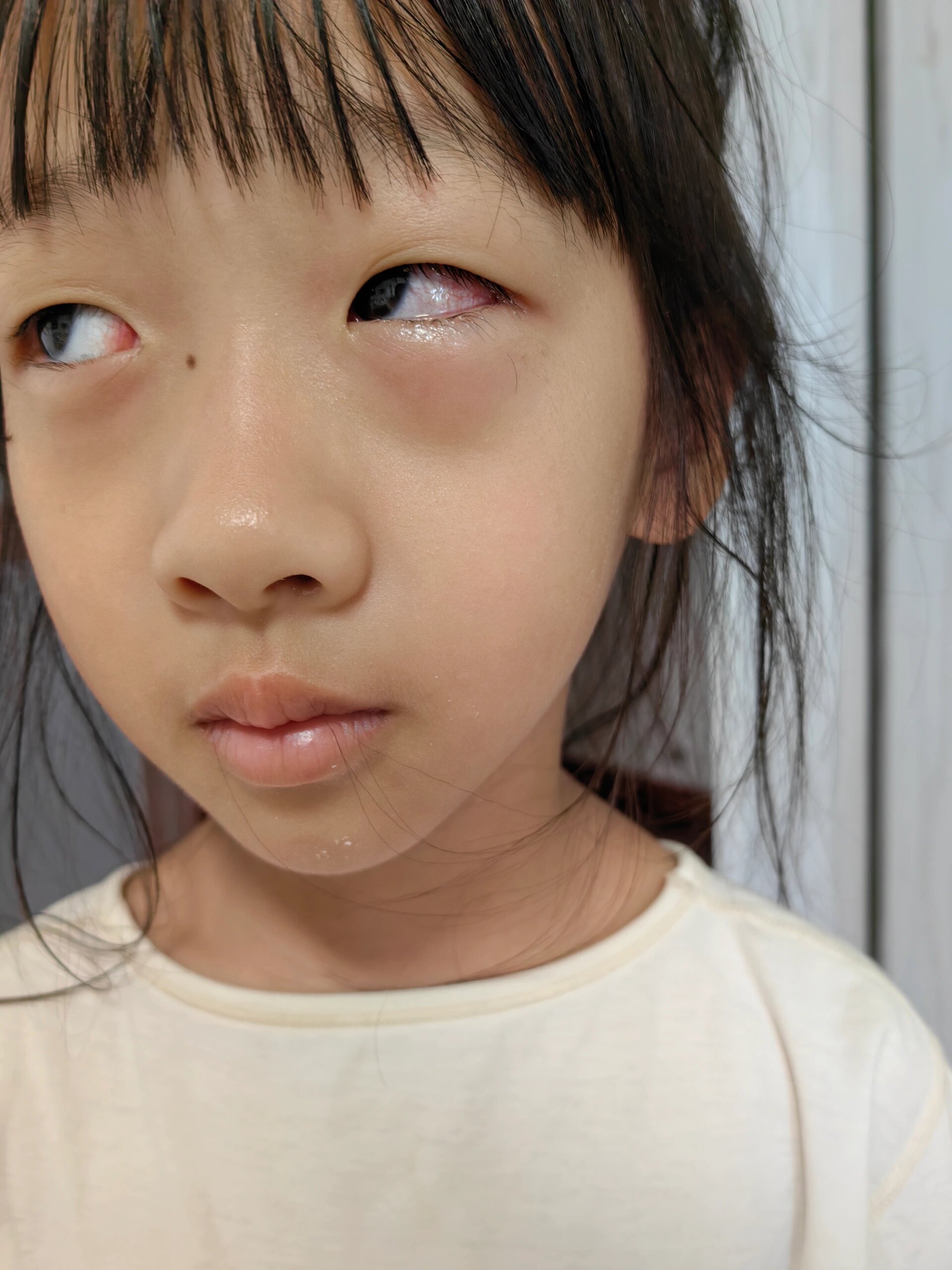 小孩儿"红眼病"该怎么用药?