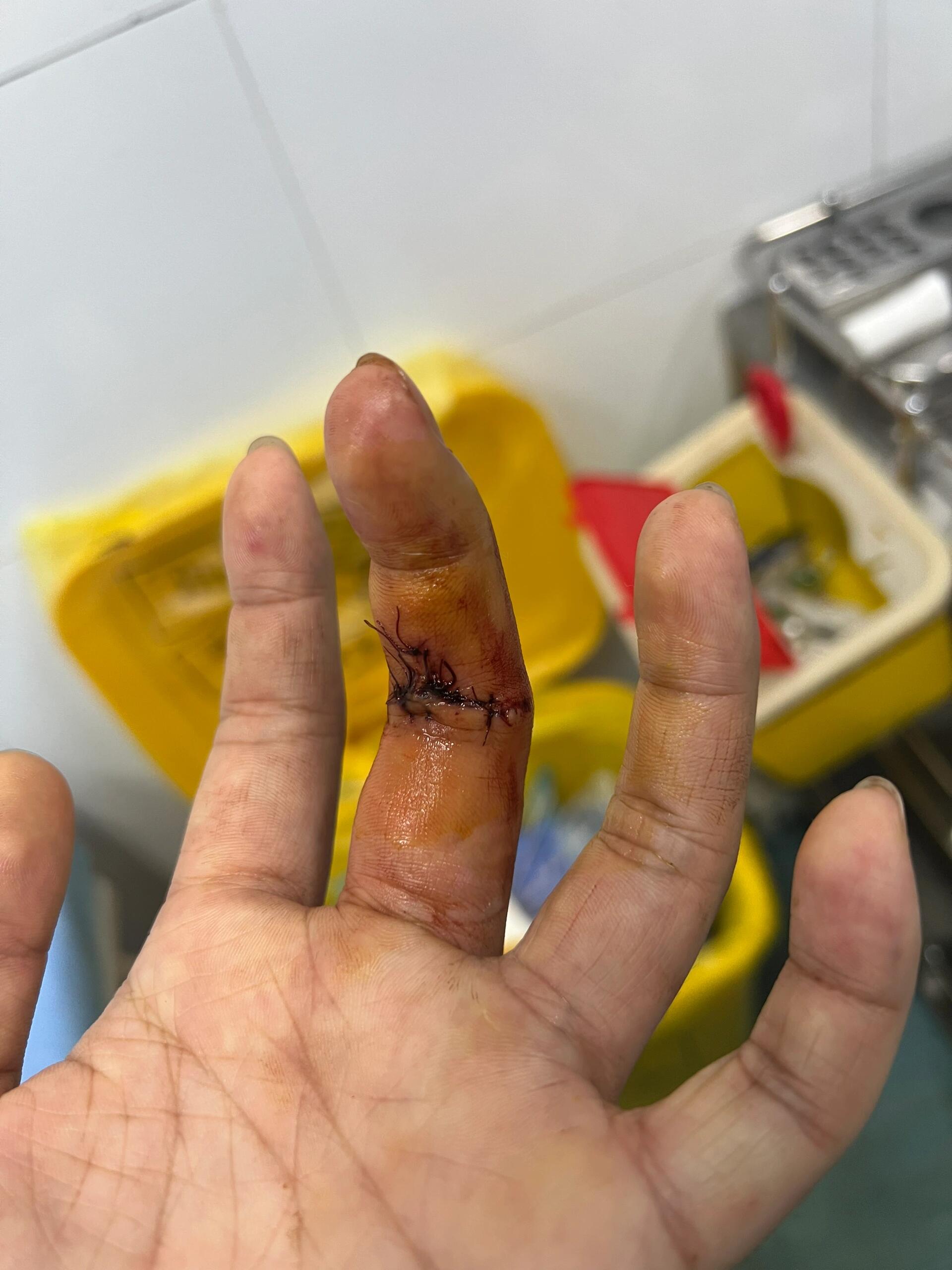 手指屈肌腱损伤恢复笔记 2