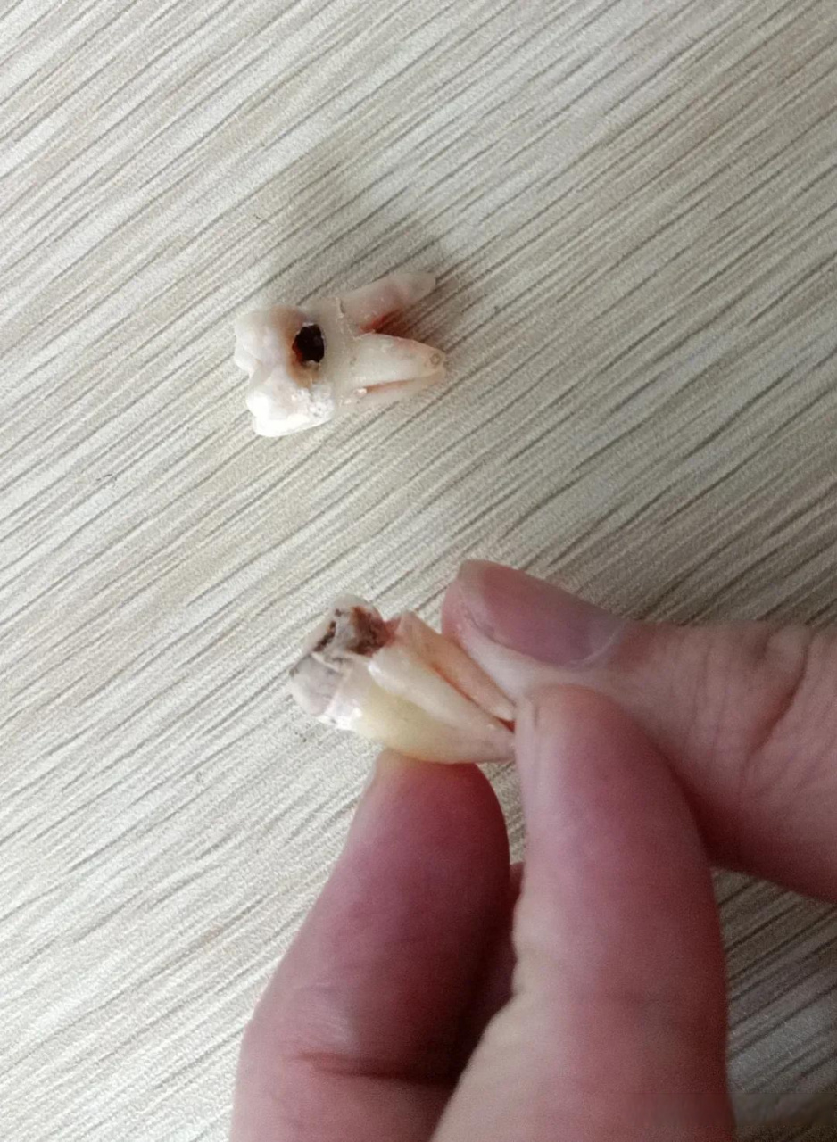 今天是拔完牙的第二天,牙齿不痛,脸也没肿,一点儿感觉都没有,那种滋味