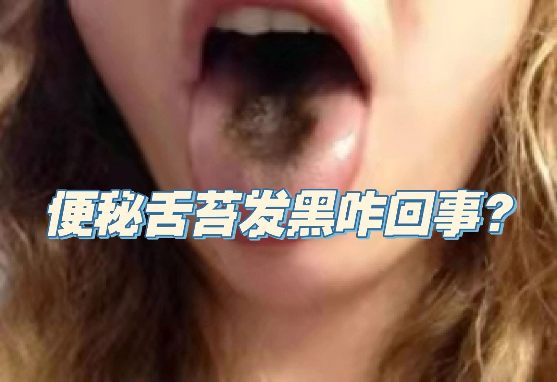 有些肠胃功能紊乱的人会出现舌苔发黑情况, 这是因为细菌毒素的刺激