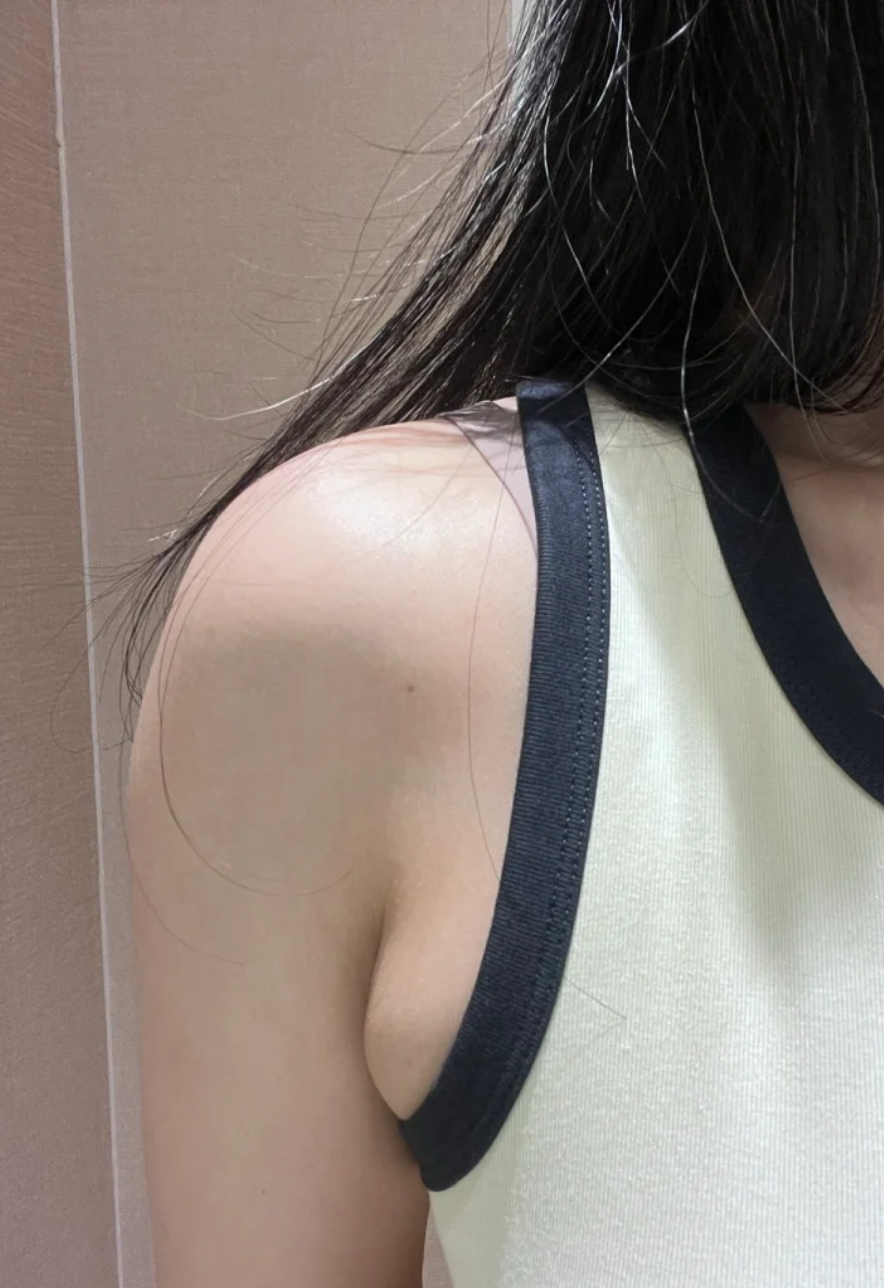 腋下副乳出现小豆子大小的疙瘩,常见原因有两种:毛囊炎和淋巴结肿大