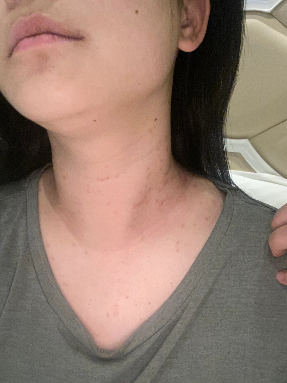 老年疣 图一是做完激光治疣的第7天,每天抹医生开的烫伤药和生长因子