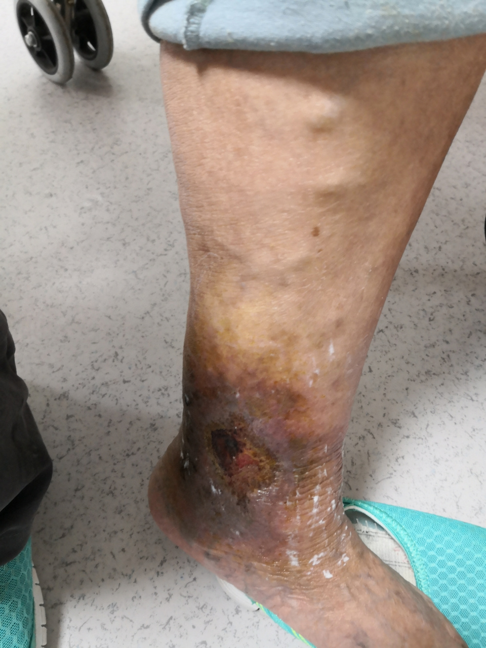 下肢静脉曲张##静脉炎