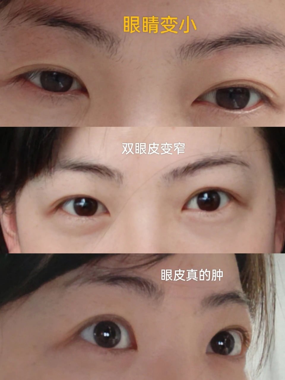 眼眶减压(突眼矫正)成功上岸第18天 眶减压第18天,眼部持续消肿,犹如