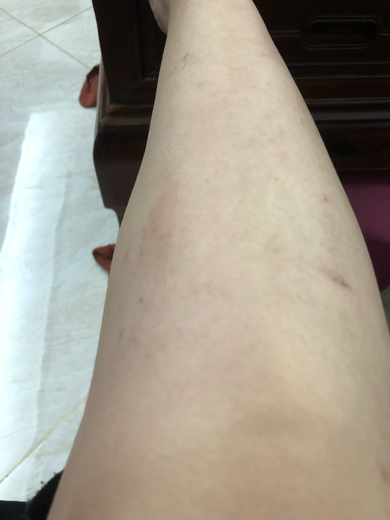 有没有同款,一到夏天小腿两侧就特别痒,越抓越痒,就算破皮还是好痒的